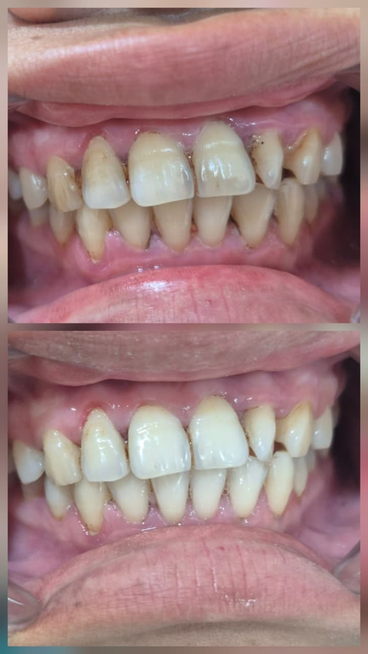 Before and after smile transformation 2